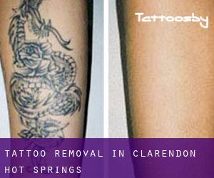 Tattoo Removal in Clarendon Hot Springs