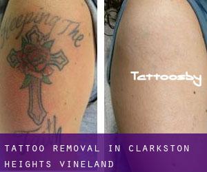 Tattoo Removal in Clarkston Heights-Vineland