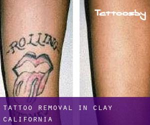 Tattoo Removal in Clay (California)