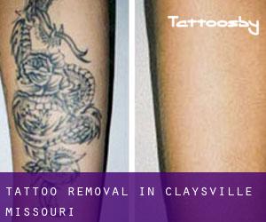 Tattoo Removal in Claysville (Missouri)