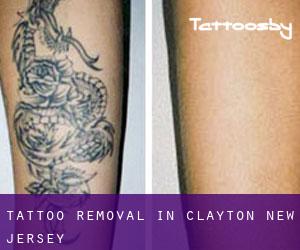 Tattoo Removal in Clayton (New Jersey)