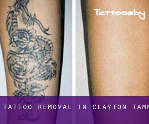 Tattoo Removal in Clayton-Tamm