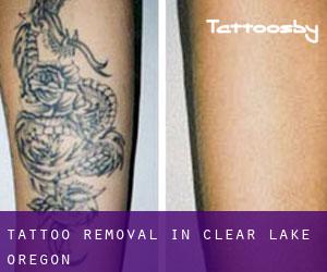 Tattoo Removal in Clear Lake (Oregon)