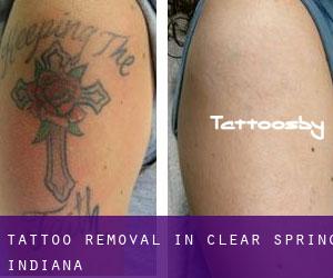 Tattoo Removal in Clear Spring (Indiana)