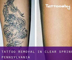 Tattoo Removal in Clear Spring (Pennsylvania)