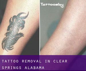 Tattoo Removal in Clear Springs (Alabama)