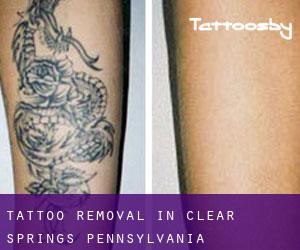 Tattoo Removal in Clear Springs (Pennsylvania)