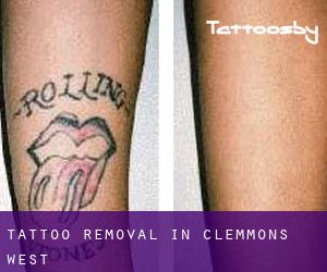 Tattoo Removal in Clemmons West