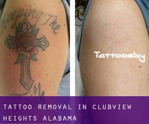 Tattoo Removal in Clubview Heights (Alabama)