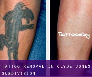 Tattoo Removal in Clyde Jones Subdivision