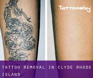 Tattoo Removal in Clyde (Rhode Island)