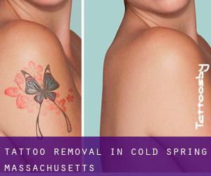 Tattoo Removal in Cold Spring (Massachusetts)