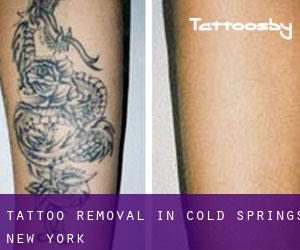Tattoo Removal in Cold Springs (New York)