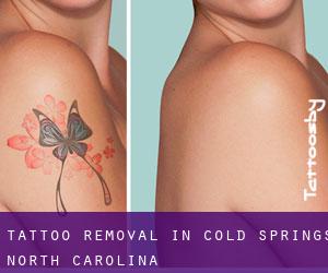 Tattoo Removal in Cold Springs (North Carolina)
