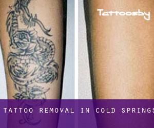 Tattoo Removal in Cold Springs