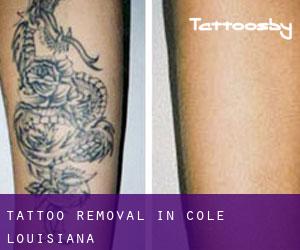 Tattoo Removal in Cole (Louisiana)