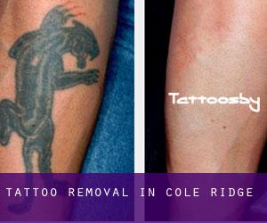 Tattoo Removal in Cole Ridge