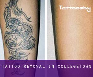 Tattoo Removal in Collegetown