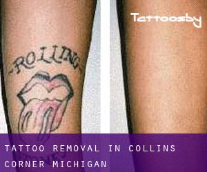 Tattoo Removal in Collins Corner (Michigan)