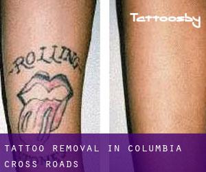 Tattoo Removal in Columbia Cross Roads
