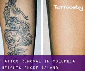 Tattoo Removal in Columbia Heights (Rhode Island)