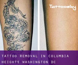 Tattoo Removal in Columbia Heights (Washington, D.C.)