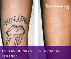 Tattoo Removal in Comanche Springs