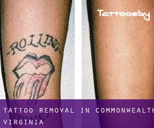 Tattoo Removal in Commonwealth (Virginia)