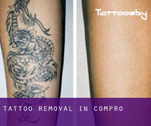 Tattoo Removal in Compro