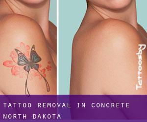 Tattoo Removal in Concrete (North Dakota)