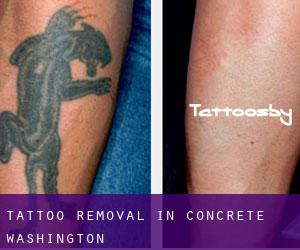 Tattoo Removal in Concrete (Washington)