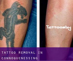Tattoo Removal in Connoquenessing