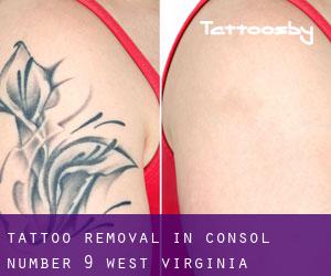 Tattoo Removal in Consol Number 9 (West Virginia)