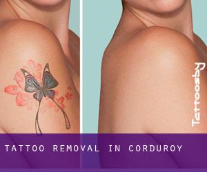 Tattoo Removal in Corduroy