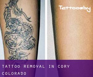 Tattoo Removal in Cory (Colorado)