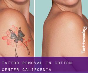 Tattoo Removal in Cotton Center (California)