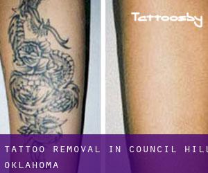 Tattoo Removal in Council Hill (Oklahoma)