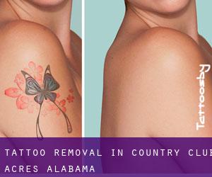 Tattoo Removal in Country Club Acres (Alabama)