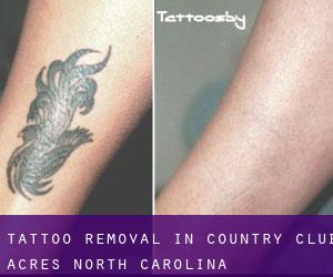 Tattoo Removal in Country Club Acres (North Carolina)