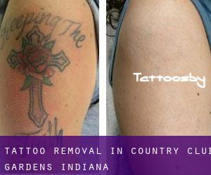 Tattoo Removal in Country Club Gardens (Indiana)