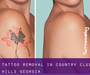 Tattoo Removal in Country Club Hills (Georgia)
