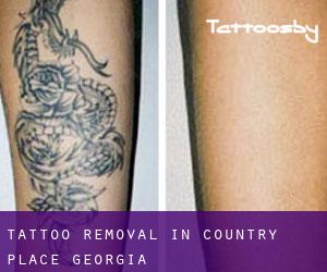 Tattoo Removal in Country Place (Georgia)