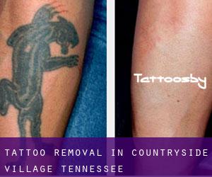 Tattoo Removal in Countryside Village (Tennessee)