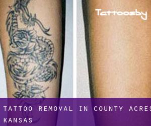 Tattoo Removal in County Acres (Kansas)