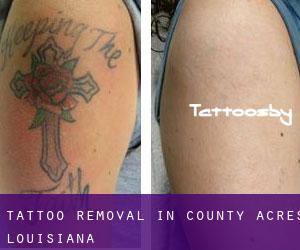 Tattoo Removal in County Acres (Louisiana)