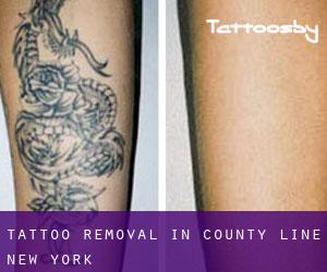 Tattoo Removal in County Line (New York)
