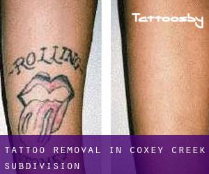Tattoo Removal in Coxey Creek Subdivision