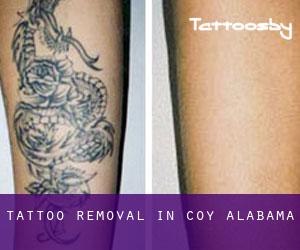 Tattoo Removal in Coy (Alabama)