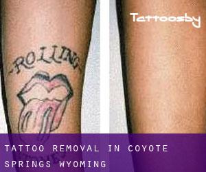 Tattoo Removal in Coyote Springs (Wyoming)