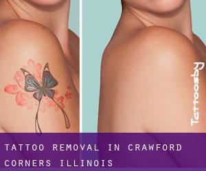 Tattoo Removal in Crawford Corners (Illinois)
